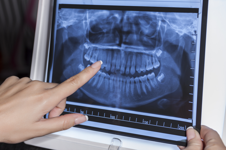 Inteligencia Artificial para detectar patologías periodontales