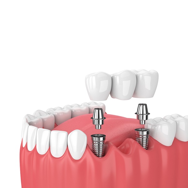 Aditamentos Dentales