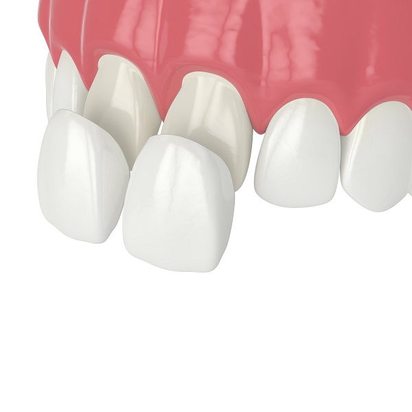 Cemento pegado de carillas