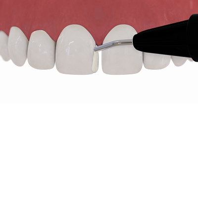 Composites Anteriores