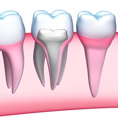 Endodoncia obturación