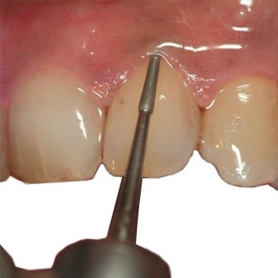 Fresas Periodontales