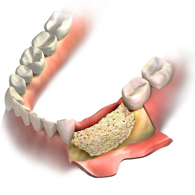 Material de relleno óseo